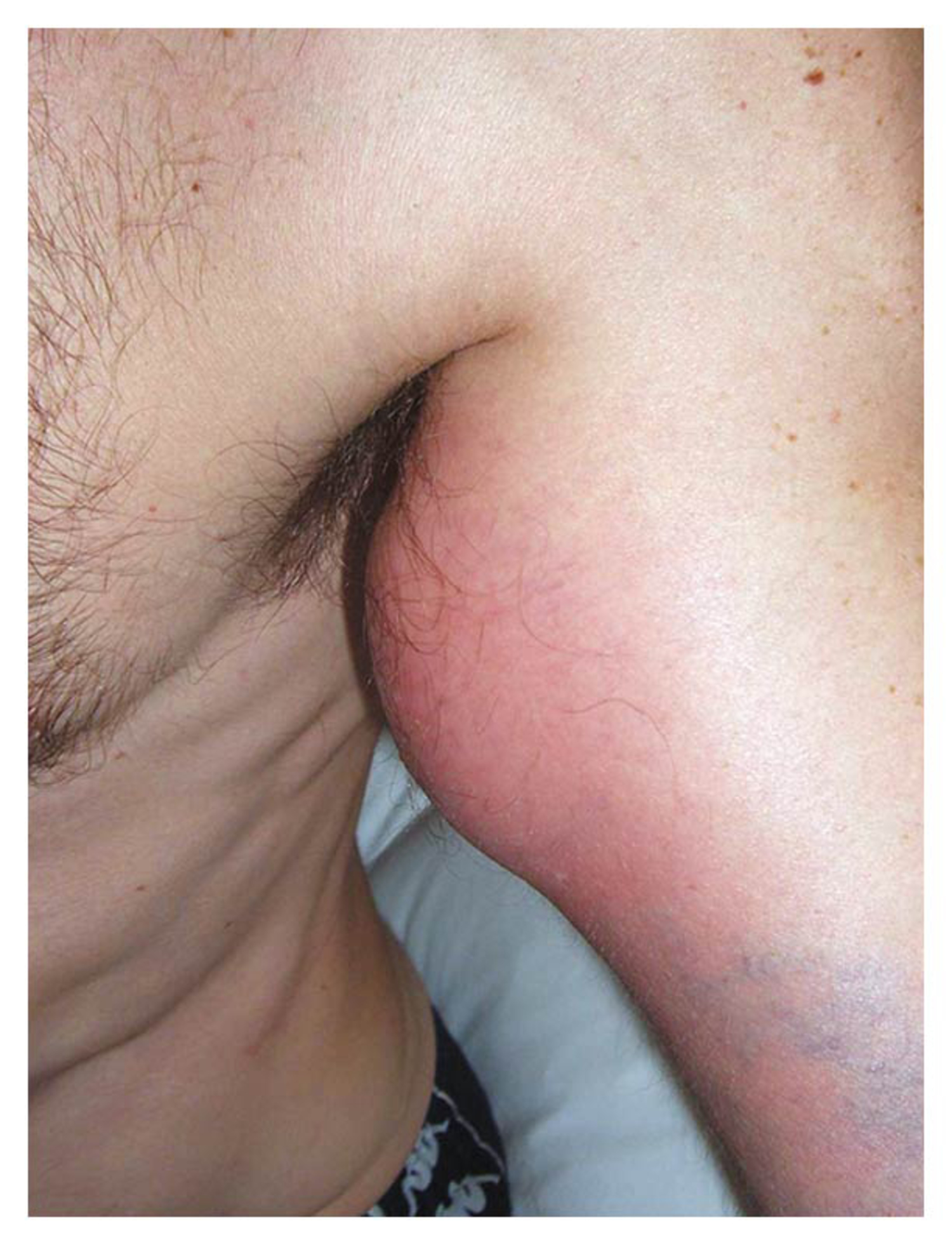 Groin Abscess Male