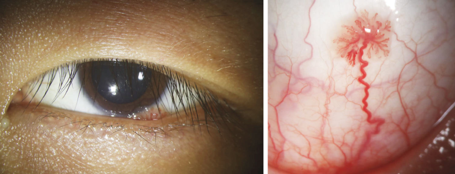 episcleral-nodule-rethinking-a-case-of-chronic-scleritis-american