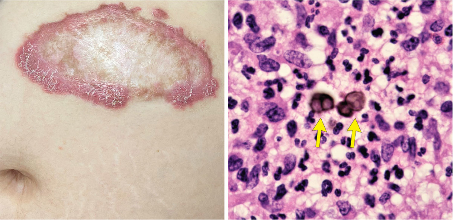 Eritema Heliotrópio e Fraqueza Muscular Proximal