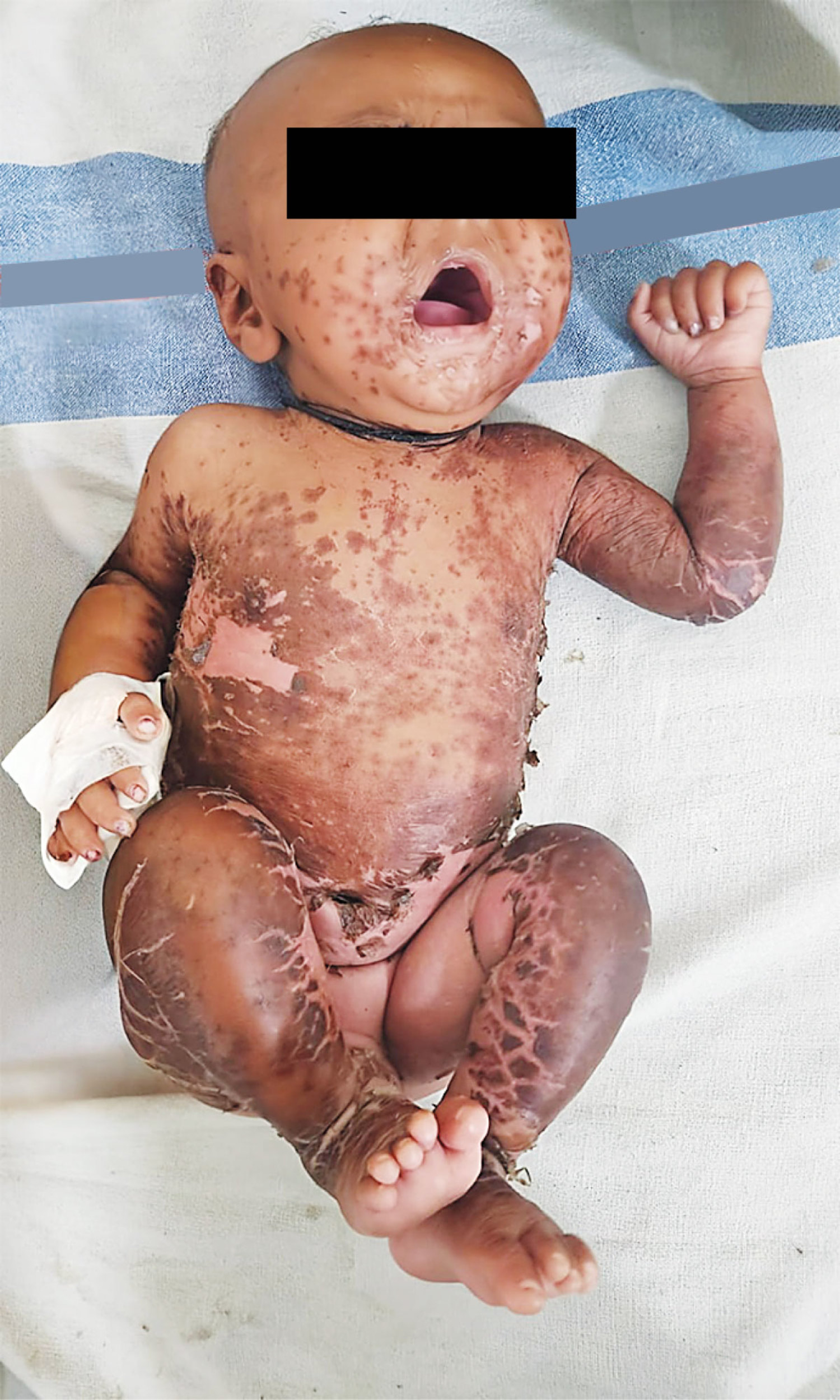Sinovite Bilateral em Paciente Imunossuprimido