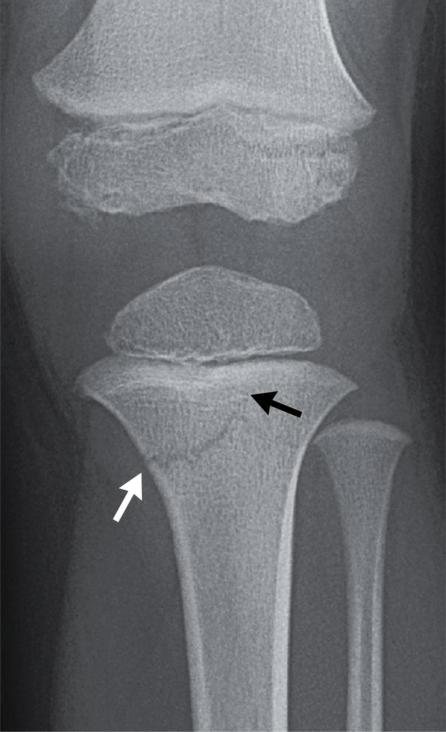 Pápulas Violáceas no Dorso das Mãos e Fraqueza Proximal